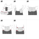 bsn Actimove®LumbaMotion